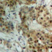 STAT4 Antibody - Immunohistochemical analysis of STAT4 (pY693) staining in human breast cancer formalin fixed paraffin embedded tissue section. The section was pre-treated using heat mediated antigen retrieval with sodium citrate buffer (pH 6.0). The section was then incubated with the antibody at room temperature and detected using an HRP conjugated compact polymer system. DAB was used as the chromogen. The section was then counterstained with hematoxylin and mounted with DPX.