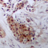 STAT4 Antibody - Immunohistochemical analysis of STAT4 staining in human breast cancer formalin fixed paraffin embedded tissue section. The section was pre-treated using heat mediated antigen retrieval with sodium citrate buffer (pH 6.0). The section was then incubated with the antibody at room temperature and detected using an HRP polymer system. DAB was used as the chromogen. The section was then counterstained with hematoxylin and mounted with DPX.