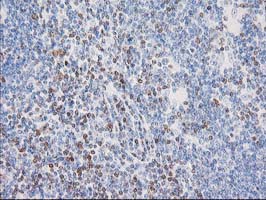 STAT4 Antibody - IHC of paraffin-embedded Human lymphoma tissue using anti-STAT4 mouse monoclonal antibody.