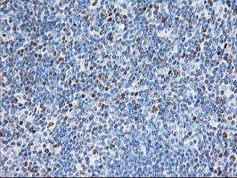 STAT4 Antibody - IHC of paraffin-embedded Human lymphoma tissue using anti-STAT4 mouse monoclonal antibody.