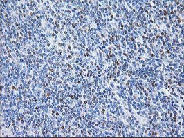 STAT4 Antibody - IHC of paraffin-embedded Human lymphoma tissue using anti-STAT4 mouse monoclonal antibody. (Heat-induced epitope retrieval by 10mM citric buffer, pH6.0, 100C for 10min).