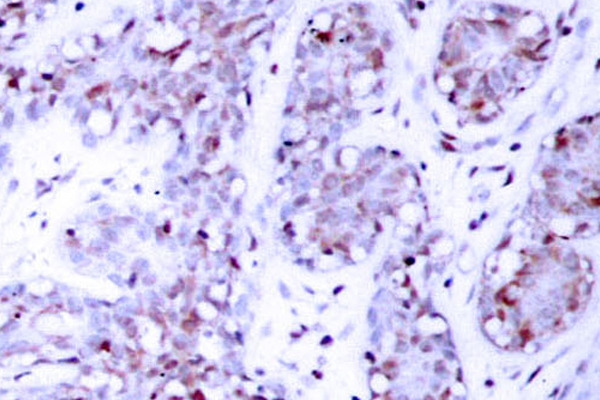 STAT4 Antibody - IHC of STAT4 (E687) pAb in paraffin-embedded human breast carcinoma tissue.