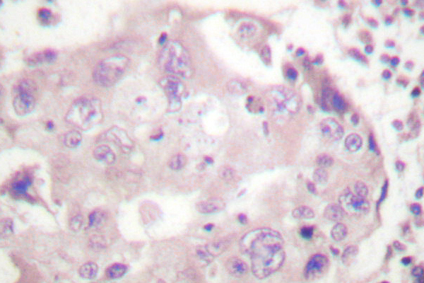 STAT4 Antibody - IHC of STAT4 (E687) pAb in paraffin-embedded human breast carcinoma tissue.