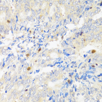 STAT4 Antibody - Immunohistochemistry of paraffin-embedded human rectal cancer tissue.