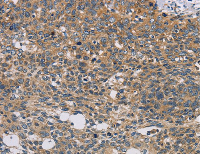 STAT4 Antibody - Immunohistochemistry of paraffin-embedded Human thyroid cancer using STAT4 Polyclonal Antibody at dilution of 1:30.