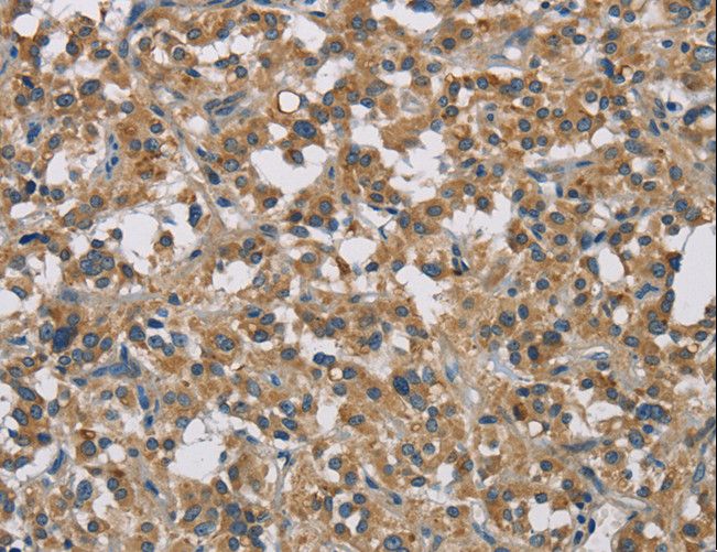 STAT4 Antibody - Immunohistochemistry of paraffin-embedded Human thyroid cancer using STAT4 Polyclonal Antibody at dilution of 1:30.