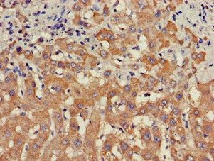 STAT4 Antibody - Immunohistochemistry of paraffin-embedded human liver cancer at dilution of 1:100