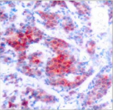 STAT4 Antibody - Detection of STAT4 (phospho-Tyr693) in paraffin-embedded human breast carcinoma tissue.