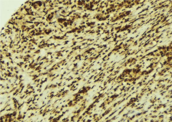 STAT4 Antibody - 1:100 staining human breast carcinoma tissue by IHC-P. The sample was formaldehyde fixed and a heat mediated antigen retrieval step in citrate buffer was performed. The sample was then blocked and incubated with the antibody for 1.5 hours at 22°C. An HRP conjugated goat anti-rabbit antibody was used as the secondary.