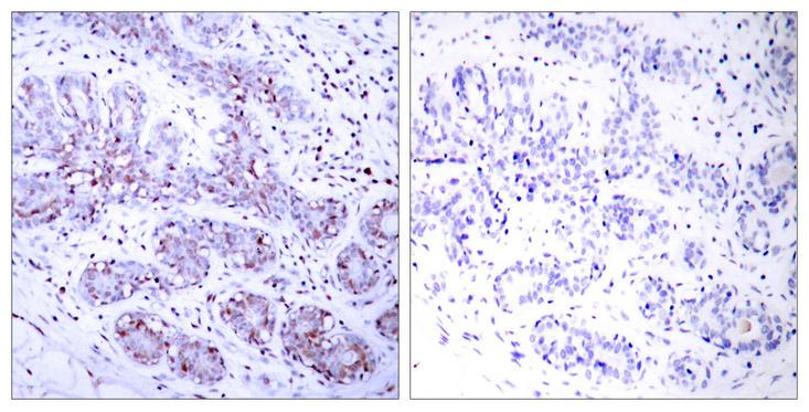 STAT4 Antibody - Peptide - + Immunohistochemical analysis of paraffin-embedded human breast carcinoma tissue using STAT4 (Ab-693) antibody.