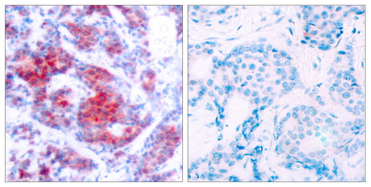 STAT4 Antibody - Immunohistochemistry analysis of paraffin-embedded human breast carcinoma, using STAT4 (Phospho-Tyr693) Antibody. The picture on the right is blocked with the phospho peptide.