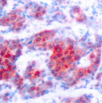STAT4 Antibody - Immunohistochemical analysis of paraffin-embedded human breast carcinoma tissue.