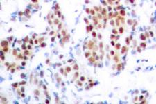 STAT5 A+B Antibody - IHC of Stat5a/b (A688) pAb in paraffin-embedded human breast carcinoma tissue.