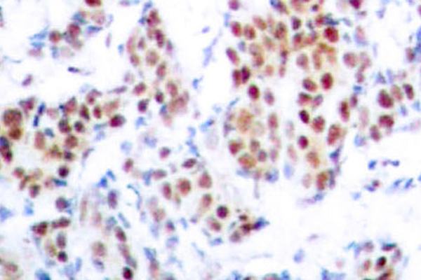 STAT5 A+B Antibody - IHC of Stat5a/b (A688) pAb in paraffin-embedded human breast carcinoma tissue.