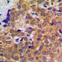 STAT5 A+B Antibody - Immunohistochemical analysis of STAT5 staining in human breast cancer formalin fixed paraffin embedded tissue section. The section was pre-treated using heat mediated antigen retrieval with sodium citrate buffer (pH 6.0). The section was then incubated with the antibody at room temperature and detected using an HRP conjugated compact polymer system. DAB was used as the chromogen. The section was then counterstained with hematoxylin and mounted with DPX.