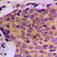 STAT5 A+B Antibody - Immunohistochemical analysis of STAT5 staining in human breast cancer formalin fixed paraffin embedded tissue section. The section was pre-treated using heat mediated antigen retrieval with sodium citrate buffer (pH 6.0). The section was then incubated with the antibody at room temperature and detected using an HRP conjugated compact polymer system. DAB was used as the chromogen. The section was then counterstained with hematoxylin and mounted with DPX.