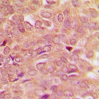 STAT5 A+B Antibody - Immunohistochemical analysis of STAT5 staining in human breast cancer formalin fixed paraffin embedded tissue section. The section was pre-treated using heat mediated antigen retrieval with sodium citrate buffer (pH 6.0). The section was then incubated with the antibody at room temperature and detected with HRP and DAB as chromogen. The section was then counterstained with hematoxylin and mounted with DPX.