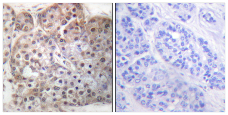 STAT5 A+B Antibody - Immunohistochemistry analysis of paraffin-embedded human breast carcinoma, using STAT5A/B (Phospho-Ser725/730) Antibody. The picture on the right is blocked with the phospho peptide.