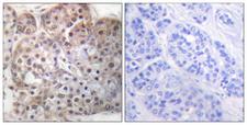 STAT5 A+B Antibody - Immunohistochemistry analysis of paraffin-embedded human breast carcinoma, using STAT5A/B (Phospho-Ser725/730) Antibody. The picture on the right is blocked with the phospho peptide.