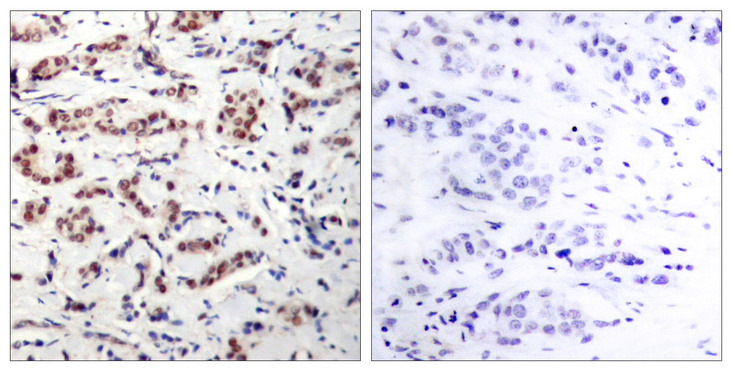 STAT5 A+B Antibody - Immunohistochemistry analysis of paraffin-embedded human breast carcinoma, using STAT5A (Phospho-Tyr694) Antibody. The picture on the right is blocked with the phospho peptide.