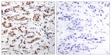 STAT5 A+B Antibody - Immunohistochemistry analysis of paraffin-embedded human breast carcinoma, using STAT5A (Phospho-Tyr694) Antibody. The picture on the right is blocked with the phospho peptide.