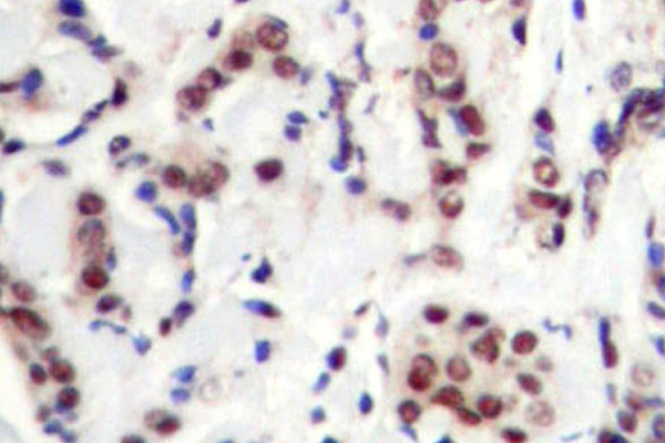 STAT5 A+B Antibody - IHC of p-Stat5a/b (Y694) pAb in paraffin-embedded human breast carcinoma tissue.