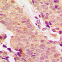 STAT5 A+B Antibody - Immunohistochemical analysis of STAT5 (pY694/699) staining in human breast cancer formalin fixed paraffin embedded tissue section. The section was pre-treated using heat mediated antigen retrieval with sodium citrate buffer (pH 6.0). The section was then incubated with the antibody at room temperature and detected using an HRP conjugated compact polymer system. DAB was used as the chromogen. The section was then counterstained with hematoxylin and mounted with DPX.