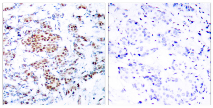 STAT5A Antibody - Immunohistochemistry analysis of paraffin-embedded human breast carcinoma tissue, using STAT5A Antibody. The picture on the right is blocked with the synthesized peptide.