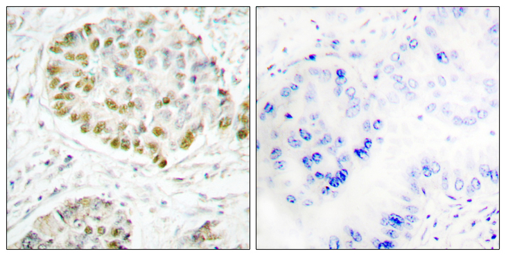 STAT5A Antibody - Immunohistochemistry analysis of paraffin-embedded human lung carcinoma tissue, using STAT5A Antibody. The picture on the right is blocked with the synthesized peptide.