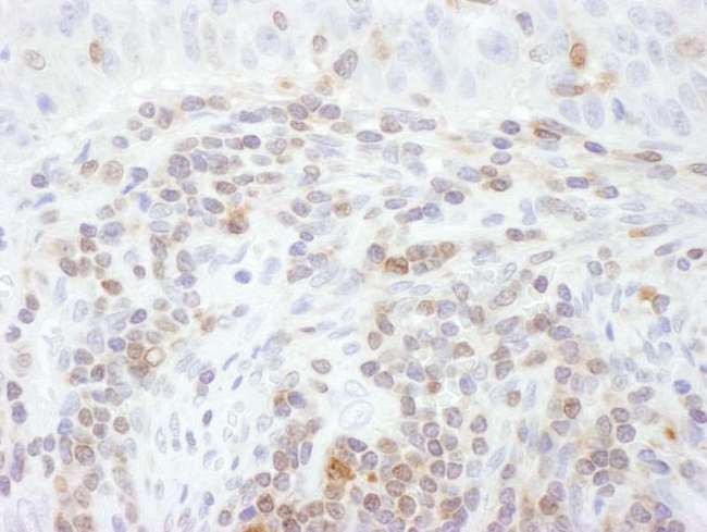 STAT5A Antibody - Detection of Human STAT5a by Immunohistochemistry. Sample: FFPE section of human lung carcinoma. Antibody: Affinity purified rabbit anti-STAT5a used at a dilution of 1:200 (1 ug/ml). Detection: DAB.