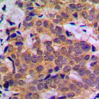 STAT5A Antibody - Immunohistochemical analysis of STAT5A staining in human breast cancer formalin fixed paraffin embedded tissue section. The section was pre-treated using heat mediated antigen retrieval with sodium citrate buffer (pH 6.0). The section was then incubated with the antibody at room temperature and detected using an HRP conjugated compact polymer system. DAB was used as the chromogen. The section was then counterstained with hematoxylin and mounted with DPX.