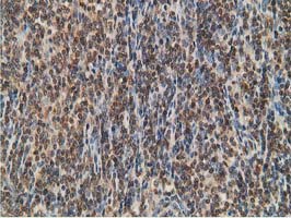 STAT5A Antibody - IHC of paraffin-embedded Human lymphoma tissue using anti-STAT5A mouse monoclonal antibody.