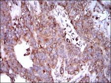 STAT5A Antibody - IHC of paraffin-embedded ovarian cancer tissues using STAT5A mouse monoclonal antibody with DAB staining.