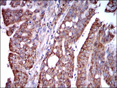 STAT5A Antibody - IHC of paraffin-embedded rectum cancer tissues using STAT5A mouse monoclonal antibody with DAB staining.