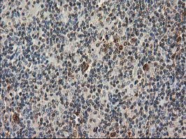 STAT5A Antibody - IHC of paraffin-embedded Human lymphoma tissue using anti-STAT5A mouse monoclonal antibody.