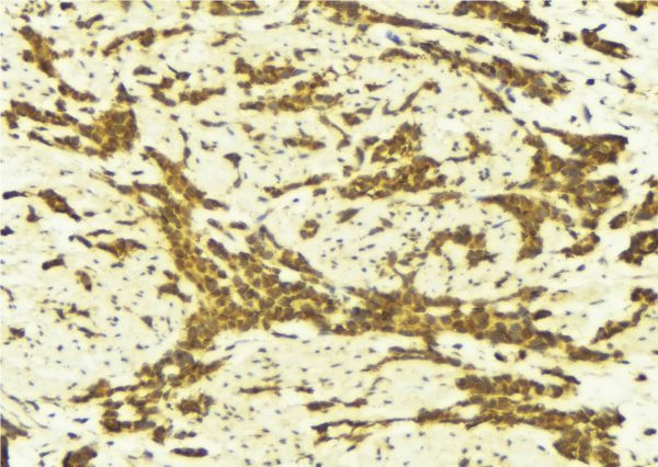STAT5A Antibody - 1:100 staining human breast carcinoma tissue by IHC-P. The sample was formaldehyde fixed and a heat mediated antigen retrieval step in citrate buffer was performed. The sample was then blocked and incubated with the antibody for 1.5 hours at 22°C. An HRP conjugated goat anti-rabbit antibody was used as the secondary.