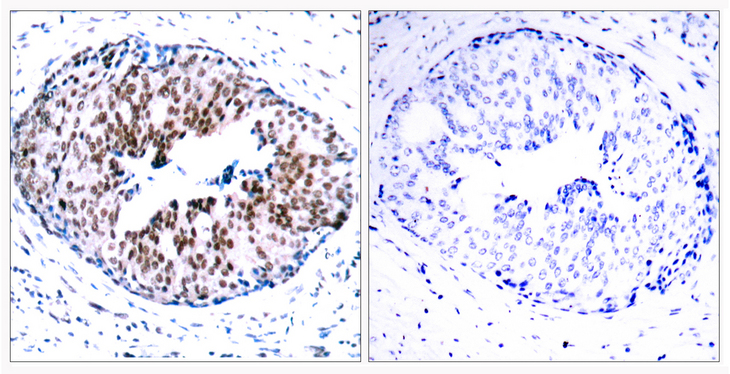 STAT5A Antibody - Immunohistochemistry analysis of paraffin-embedded human breast carcinoma, using STAT5A (Phospho-Ser780) Antibody. The picture on the right is blocked with the phospho peptide.