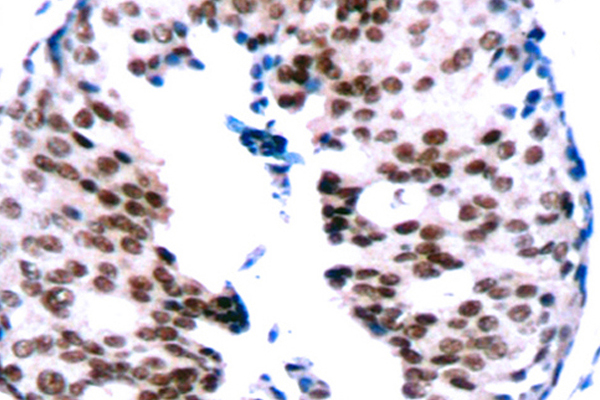STAT5A Antibody - IHC of p-STAT5A (S780) pAb in paraffin-embedded human breast carcinoma tissue.