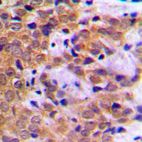 STAT5A Antibody - Immunohistochemical analysis of STAT5A (pS780) staining in human breast cancer formalin fixed paraffin embedded tissue section. The section was pre-treated using heat mediated antigen retrieval with sodium citrate buffer (pH 6.0). The section was then incubated with the antibody at room temperature and detected using an HRP conjugated compact polymer system. DAB was used as the chromogen. The section was then counterstained with hematoxylin and mounted with DPX.