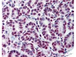 STAT5A Antibody - Anti-Stat5 pY694 Monoclonal Antibody - Immunohistochemistry. Immunohistochemistry using Anti-Stat5 pY694 monoclonal antibody shows detection of phosphorylated Stat5pY694 in human breast tissue (40X). The antibody was used a dilution to 20 ug/mL. The image shows breast epithelium with moderate nuclear staining. Tissue was formalin fixed and paraffin embedded. Antigen retrieval: steam sections in 0.1 M sodium citrate buffer, pH 6, for 20 min. The image shows the localization of antibody as the precipitated red signal, with a hematoxylin purple nuclear counterstain. Personal communication, Andrew Elston, Lifespan Biosciences, Seattle, WA.