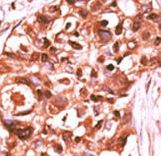 STAT5A Antibody - Formalin-fixed and paraffin-embedded human cancer tissue reacted with the primary antibody, which was peroxidase-conjugated to the secondary antibody, followed by DAB staining. This data demonstrates the use of this antibody for immunohistochemistry; clinical relevance has not been evaluated. BC = breast carcinoma; HC = hepatocarcinoma.