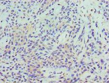 STAT5B Antibody - Immunohistochemistry of paraffin-embedded human breast cancer using antibody at 1:100 dilution.