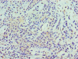 STAT5B Antibody - Immunohistochemistry of paraffin-embedded human breast cancer using STAT5B Antibody at dilution of 1:100