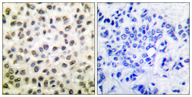 STAT5B Antibody - Immunohistochemistry analysis of paraffin-embedded human breast carcinoma tissue, using STAT5B Antibody. The picture on the right is blocked with the synthesized peptide.