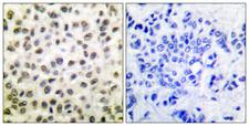 STAT5B Antibody - Immunohistochemistry analysis of paraffin-embedded human breast carcinoma tissue, using STAT5B Antibody. The picture on the right is blocked with the synthesized peptide.