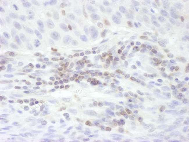 STAT5B Antibody - Detection of Human STAT5b by Immunohistochemistry. Sample: FFPE section of human lung carcinoma. Antibody: Affinity purified rabbit anti-STAT5b used at a dilution of 1:200 (1 ug/ml). Detection: DAB.