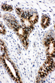 STAT5B Antibody - STAT5B / STAT antibody. IHC(P): Human Breast Cancer Tissue.