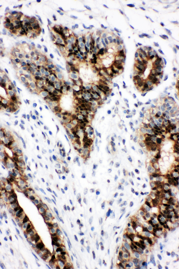 STAT5B Antibody - STAT5B / STAT antibody. IHC(P): Human Breast Cancer Tissue.