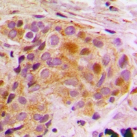 STAT5B Antibody - Immunohistochemical analysis of STAT5B staining in human breast cancer formalin fixed paraffin embedded tissue section. The section was pre-treated using heat mediated antigen retrieval with sodium citrate buffer (pH 6.0). The section was then incubated with the antibody at room temperature and detected using an HRP conjugated compact polymer system. DAB was used as the chromogen. The section was then counterstained with hematoxylin and mounted with DPX.