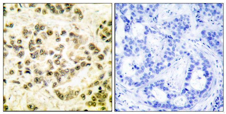 STAT5B Antibody - Immunohistochemistry analysis of paraffin-embedded human breast carcinoma, using STAT5B (Phospho-Ser731) Antibody. The picture on the right is blocked with the phospho peptide.